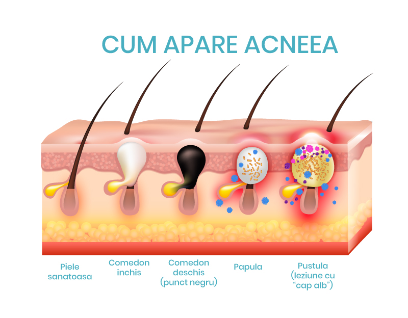 Mecanismul de aparitie al acneei