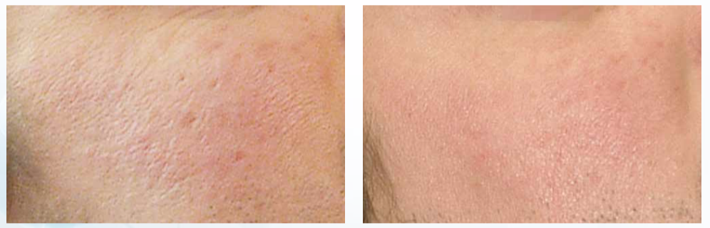 Rezultate PRX-T33 pentru cicatrici acnee 